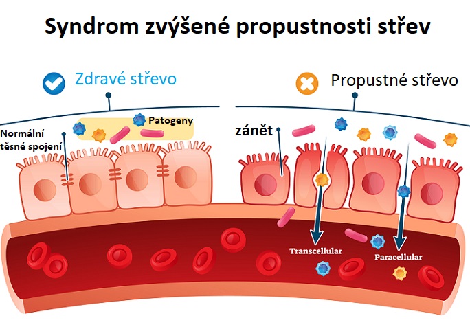 Syndrom zvýšené propustnosti střev - ilustrace