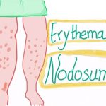 Erythema Nodosum – co je to – příznaky, příčiny a léčba