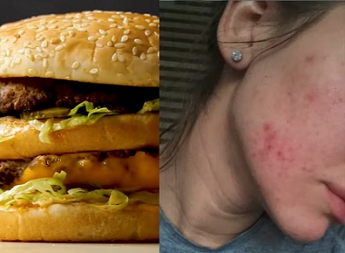 7 potravin, které mohou způsobovat vaše akné