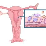 Pánevní zánětlivá nemoc – co je to – příznaky, příčiny a léčba
