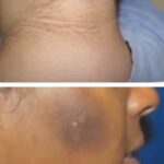 Akantóza (acanthosis nigricans) – co je to – příznaky, příčiny a léčba