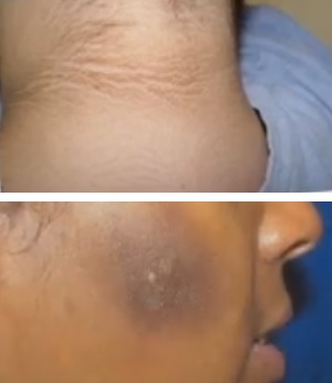 Takto může vypadat stav acanthosis nigricans