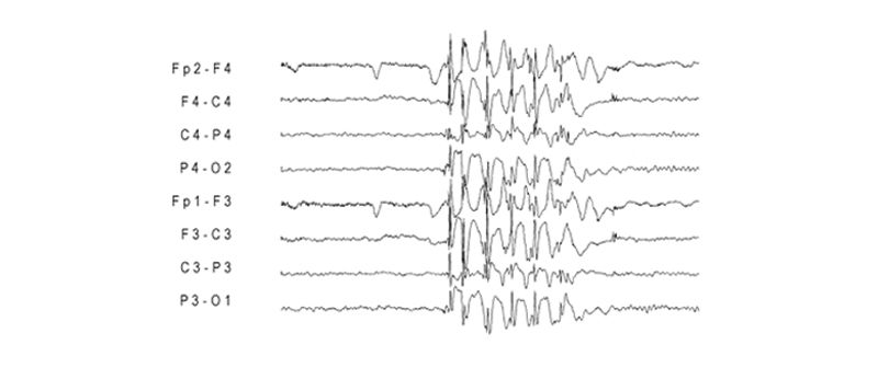 Zaznamenaná mozková aktivita pacienta s fotosenzitivní epilepsií.