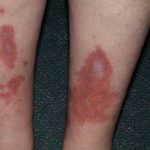 Necrobiosis lipoidica (diabeticorum) – co to je – příznaky, příčiny a léčba