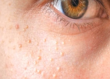 Eruptivní xantomatóza se může objevit i kolem očí.