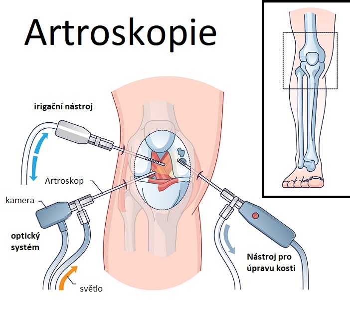 Artroskopie - ilustrace