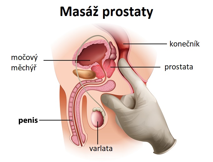 Masáž prostaty - ilustrace