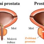 Chronická prostatitida neboli chronický zánět prostaty – co je to – příznaky, příčiny a léčba