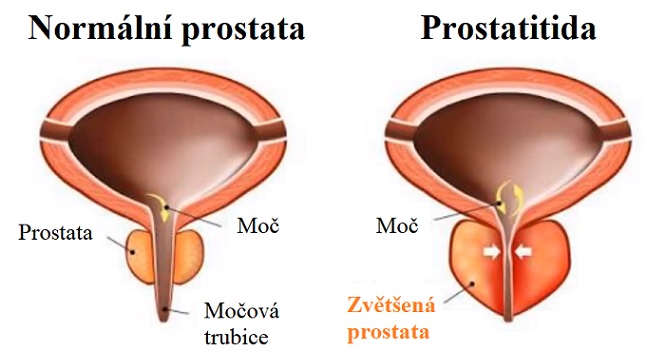 A krónikus prosztatagyulladás remissziójának időtartama