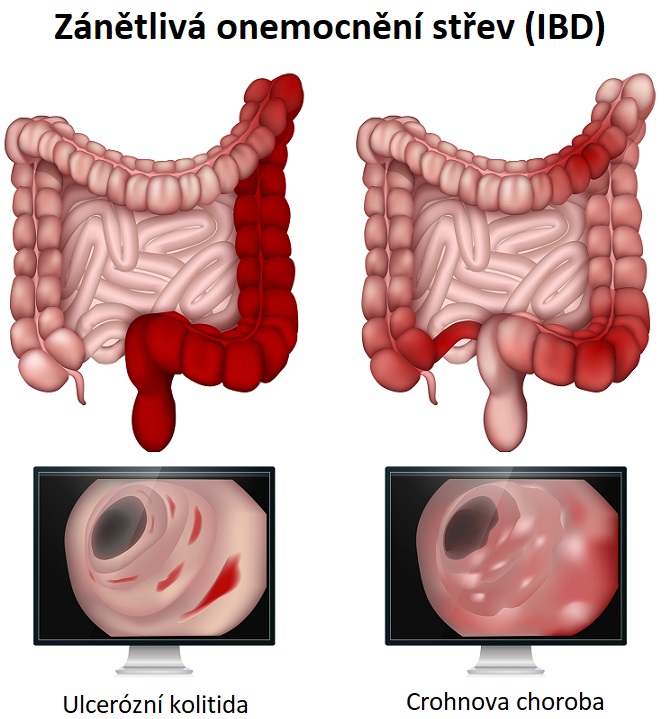 Zánětlivá onemocnění střev - ilustrace