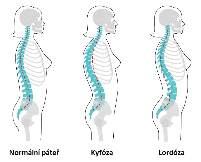 Normální páteř x Kyfóza x Lordóza