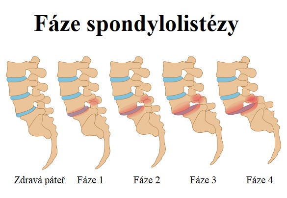 Fáze spondylolistézy