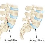 Spondylolistéza – co je to – příznaky, příčiny a léčba – cviky, které pomáhají