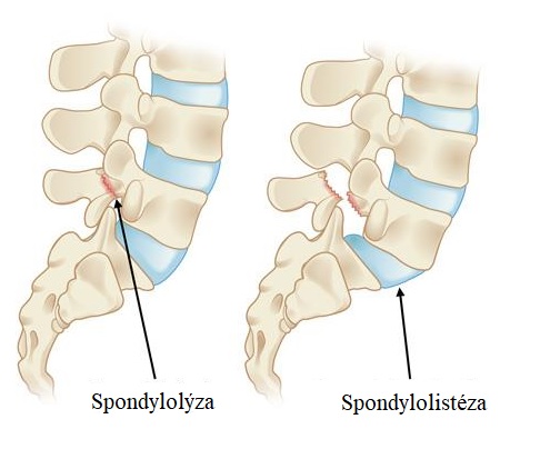 Spondylolýza je často předchůdcem spondylolistézy.