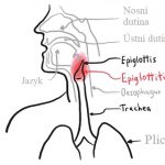 Zánět hrtanové příklopky – epiglotitida – příznaky, příčiny a léčba