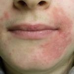 Periorální dermatitida (dermatitis perioralis) – příznaky, příčiny a léčba