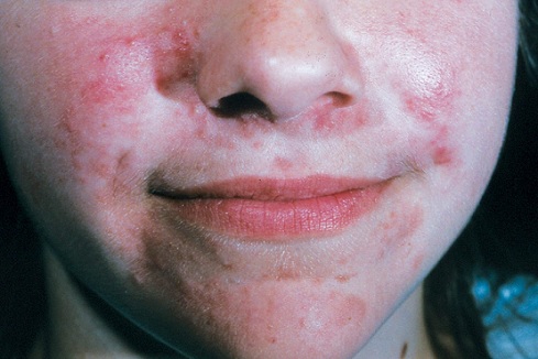 Periorální dermatitida v oblasti nosu