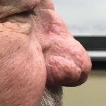 Rhinophyma („opilecký“ červený nos) – jak na tento problém?