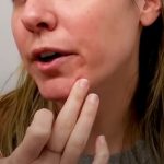 Jak se vyhnout ekzému a akné na obličeji kvůli nošení roušky?