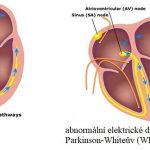 Wolff-Parkinson-Whiteův (WPW) syndrom – příznaky, příčiny a léčba