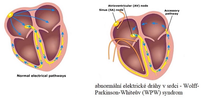 WPW syndrom