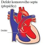 Defekt (síňového) komorového septa (přepážky) – příznaky, příčiny a léčba