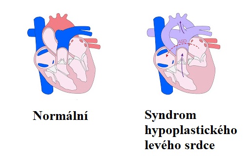 Syndrom hypoplastického levého srdce