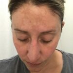 Melasma (chloasma) v těhotenství – jak na ni?