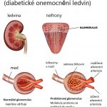 Diabetická nefropatie (diabetické onemocnění ledvin) – co je to – příznaky, příčiny a léčba
