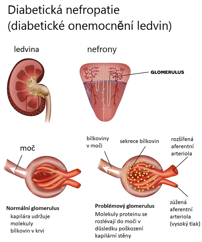 Diabetická nefropatie - ilustrace