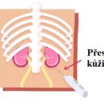 Biopsie ledvin (renální biopsie) – kdy, jak a proč se dělá?