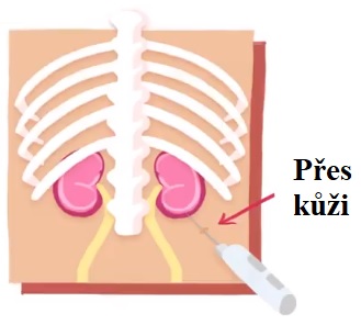 Biopsie ledviny je lékařský výkon, při němž je odebrán vzorek tkáně ledviny pomocí bioptické jehly.