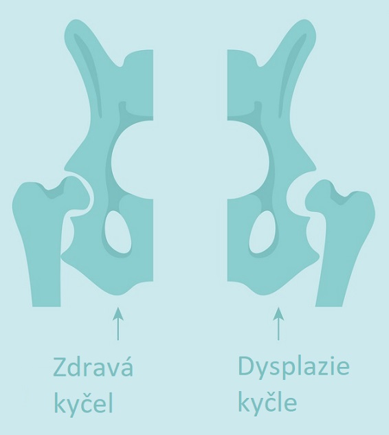 Dysplazie kyčle - ilustrace