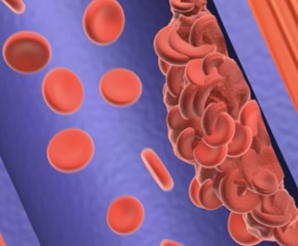 Hluboká žilní trombóza je stav, kdy se z nějaké příčiny vytvoří uvnitř žíly krevní sraženina.
