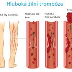 Posttrombotický syndrom – komplikace hluboké žilní trombózy – příznaky, příčiny a léčba