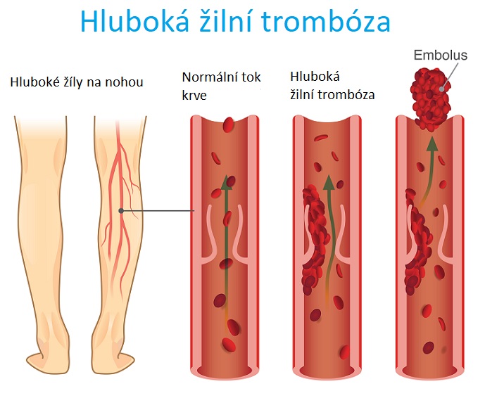 Hluboká žilní trombóza - ilustrace