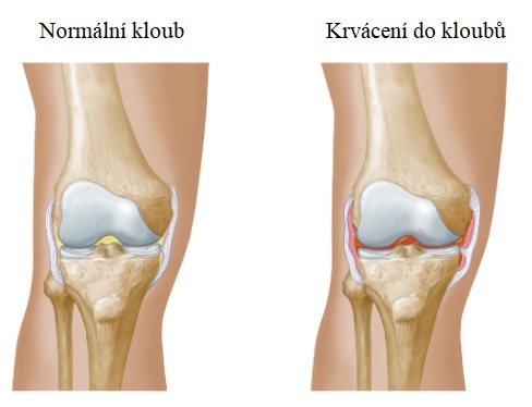 Krvácení do klubů je jedním z příznaků vrozené hemofilie