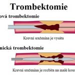 Trombektomie – co je to a kdy se provádí? Co je embolus vs trombus?