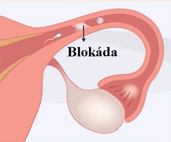 Neprůchodnost vejcovodů patří mezi poměrně časté příčiny ženské neplodnosti