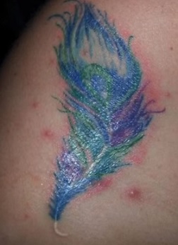 Akné v tetování - je to nebezpečné? Jak na něj?