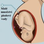 Oligohydramnion – snížené množství plodové vody – příznaky, příčiny a léčba