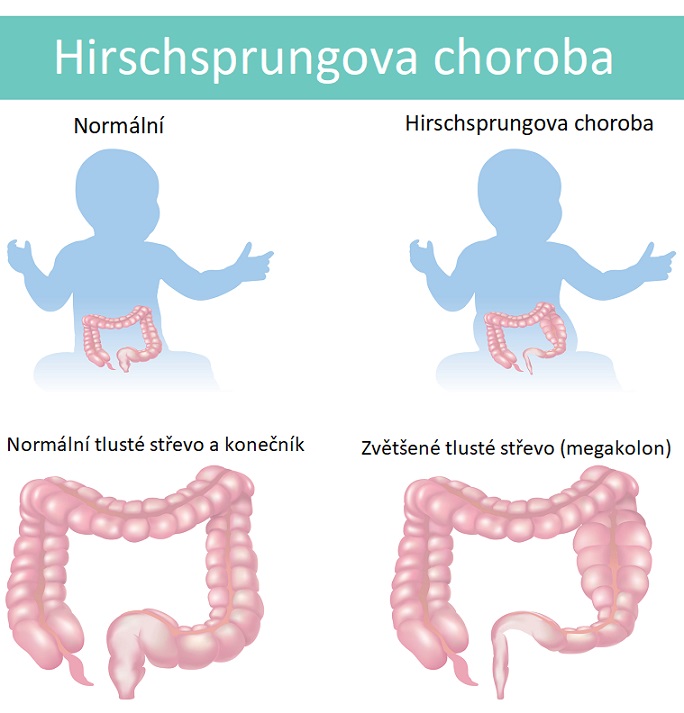 Hirschsprungova choroba - ilustrace