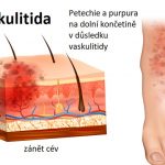 Vaskulitida – záněty cév – příznaky, příčiny a léčba