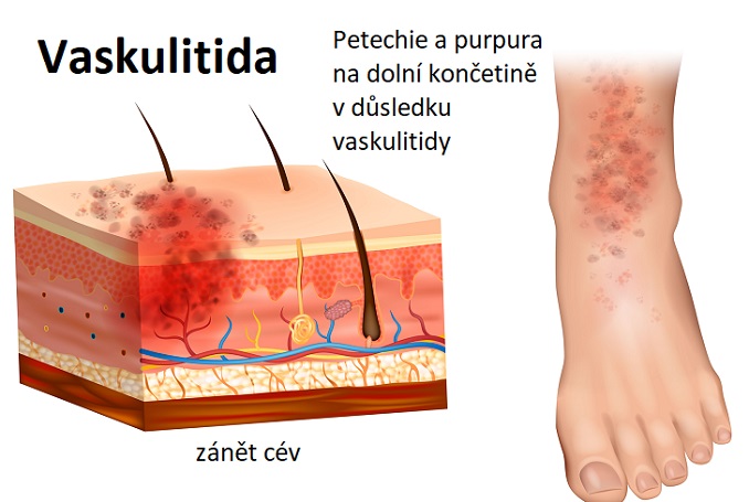 Vaskulitida - zánět cév