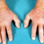 Duhringova choroba či Duhringova dermatitida (Dermatitis herpetiformis) – co je to – příznaky, příčiny a léčba