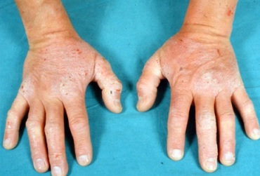 Duhringova dermatitida (Dermatitis herpetiformis Duhring, Duhringův syndrom) je kožní projev nesnášenlivosti lepku