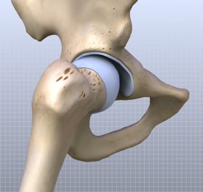Takto vypadá kyčelní kloub v kloubní jamce