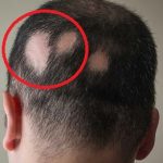 Alopecia areata – vše co potřebujete vědět – příznaky, příčiny a léčba