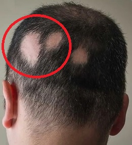 Alopecia areata - takto může vypadat