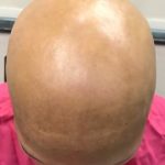 Alopecia universalis – co je to – příznaky, příčiny a léčba